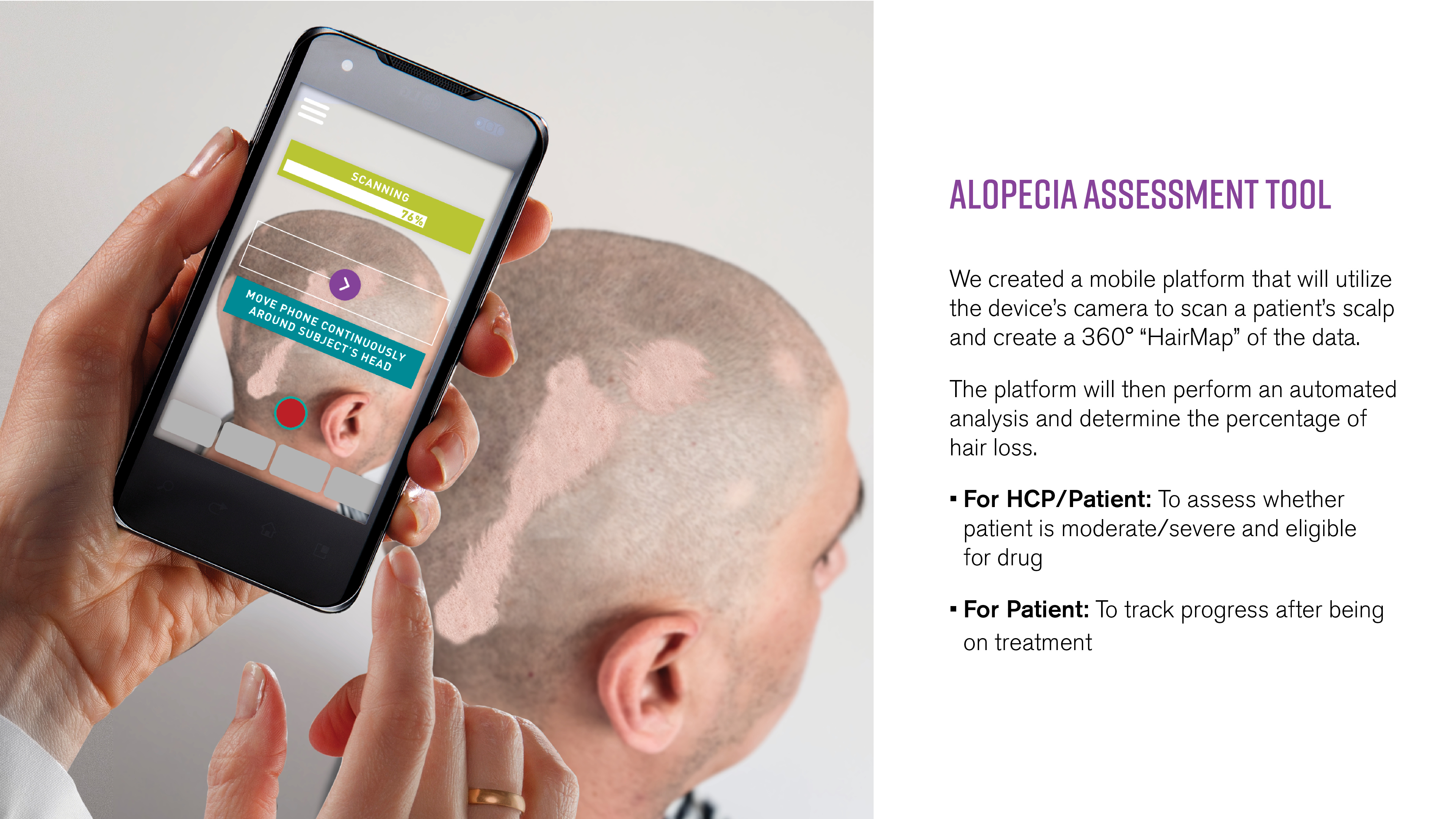Alopecia Areata JAK-TEC Inhibitor
